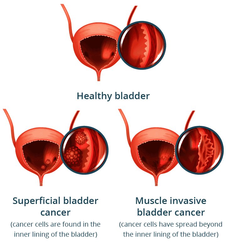 Healthy bladder vs bladder cancer stages – superficial and muscle invasive bladder cancer explained by Dr. Nilanjan Mitra, uro oncology doctor in Kolkata